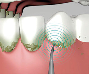 Ultrasonic 2x1 a 59,99€