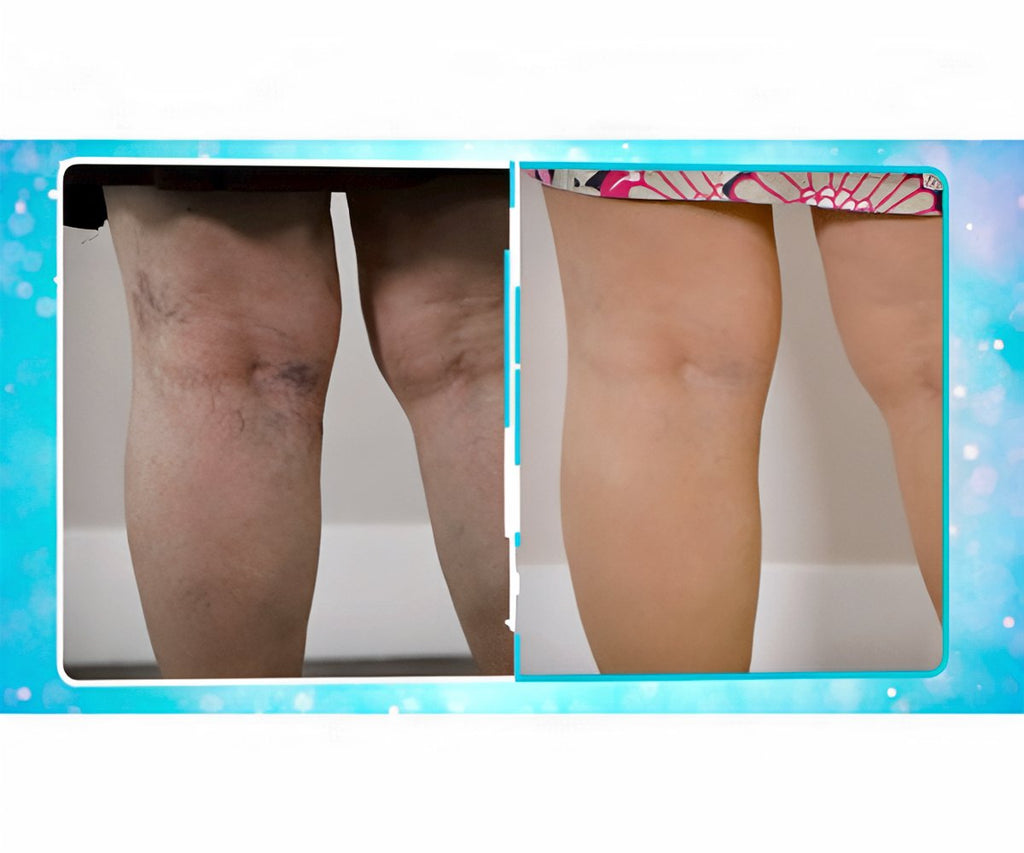 Veins Gone 2x1 a 972 CZK